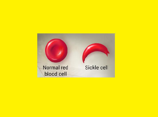 Sickle cell Anemia – Treatment Symptoms Causes Diagnosis Genetics