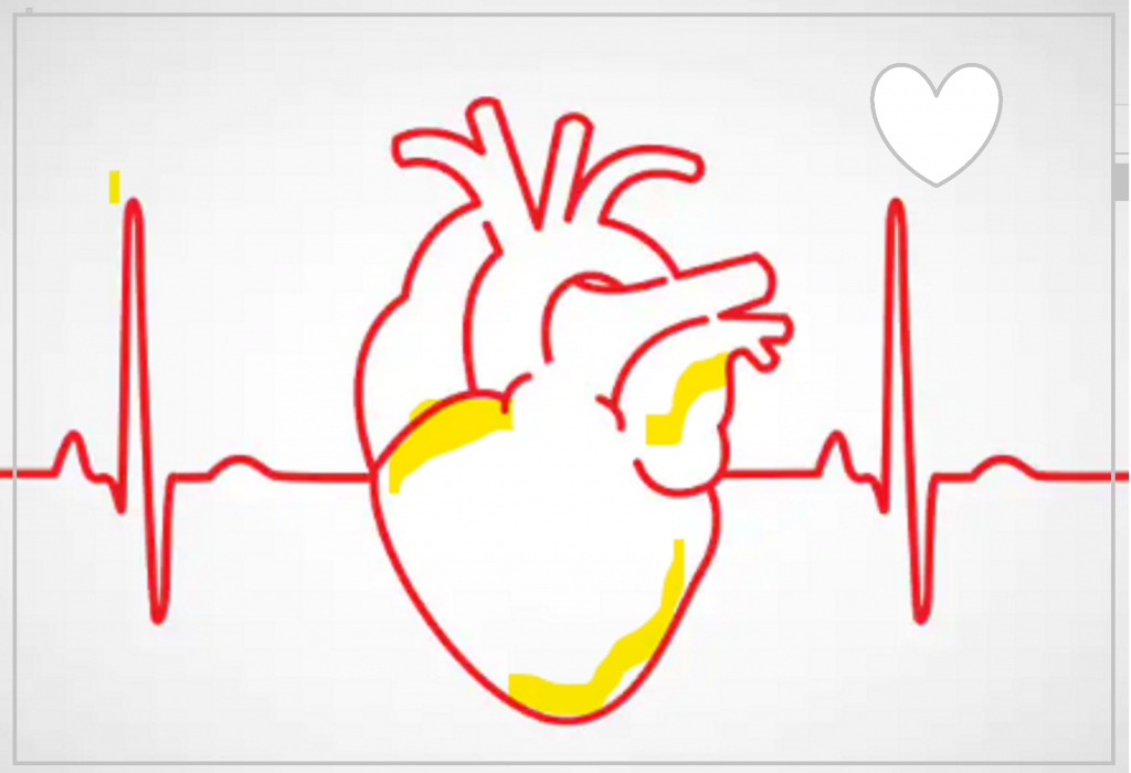 Arrhythmia Pharmacology Exam Guide MBBS B. Pharmacy M. PhaRMACY PDF